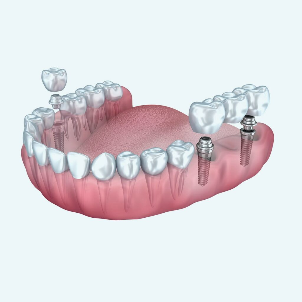 Your Guide to Understanding and Choosing the Best Tooth Replacement Option at Smart Smile Dentistry