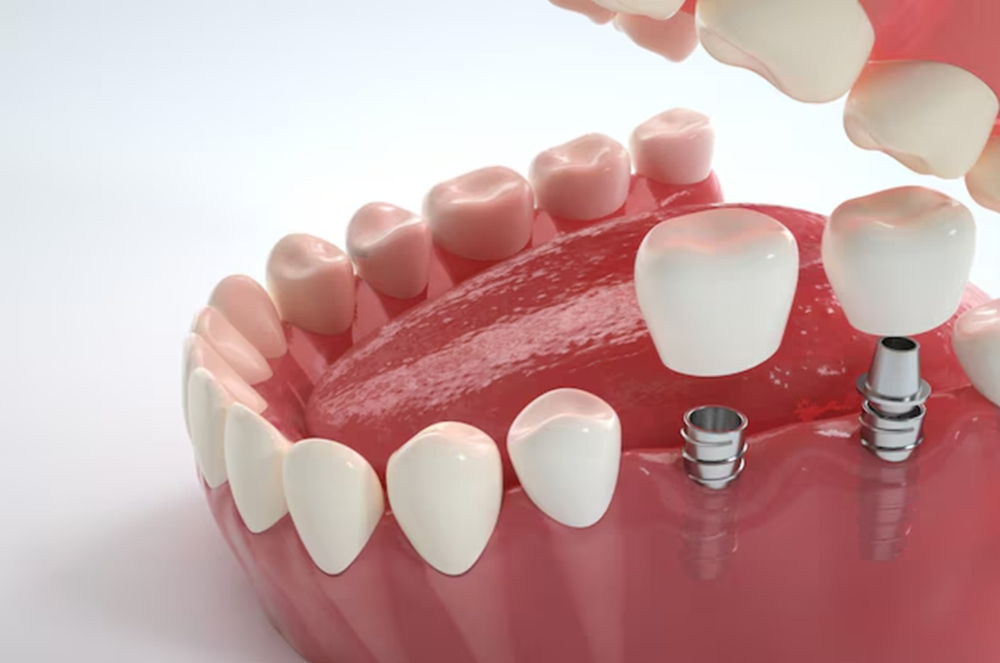 Dental implants in Gainesville