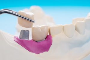 How Do You Know If You Need A Dental Crowns?